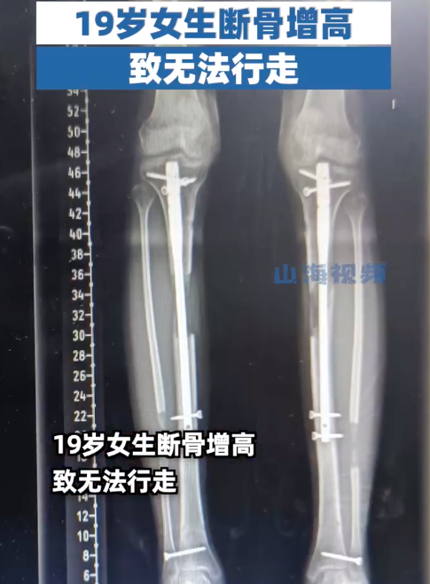 19岁女生断骨增高后无法行走！断骨增高四个字听起来不可怕吗