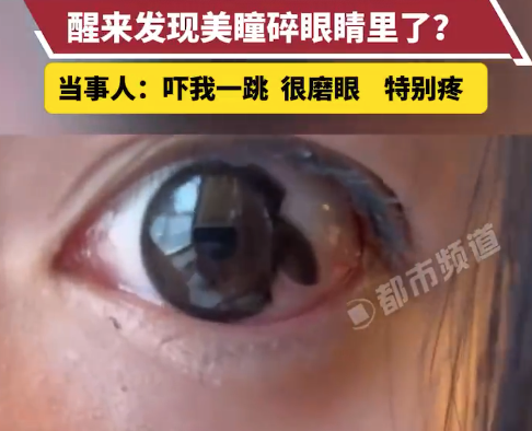 女生火车上戴美瞳睡觉忘记摘直接碎眼里