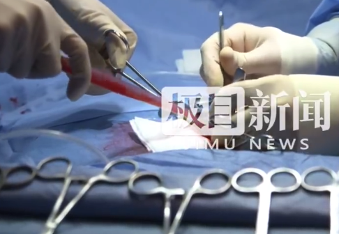 女子吃生菜卷烤肉体内取出20厘米蛔虫 专家紧急提醒：生菜卷烤肉暗藏风险