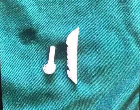 西安一女子做隆鼻手术 一年后假体露出 西安一女子做隆鼻手术 一年后