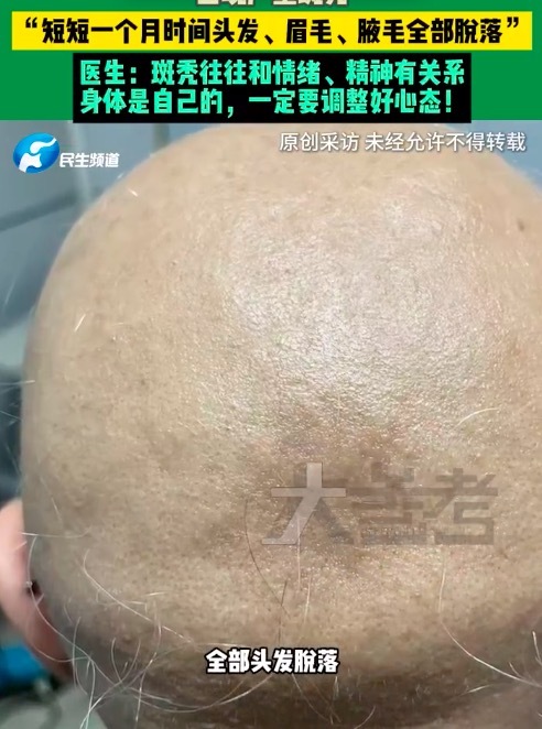20岁女孩断崖式分手后全身毛发脱落