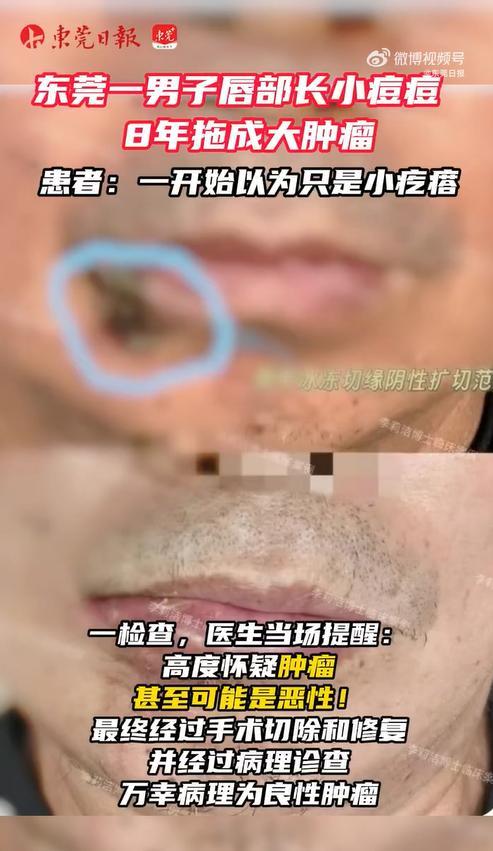 东莞一男子把唇上肿瘤当痘痘挤了8年