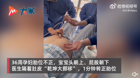 医生隔着妈妈肚皮将宝宝调了个头，上演1分钟乾坤大挪移