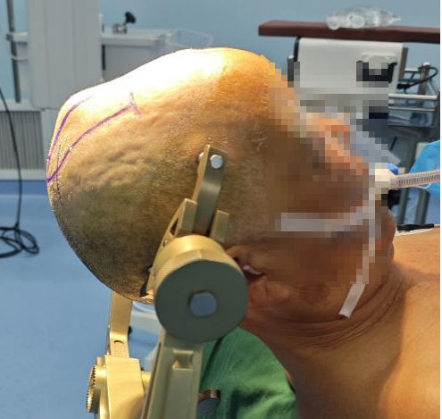 精准“拆弹”,守护生命中枢——银丰(济南)医院神经肿瘤科成功开展颅骨+硬脑膜转移瘤切除+3D打印钛网修补成型术