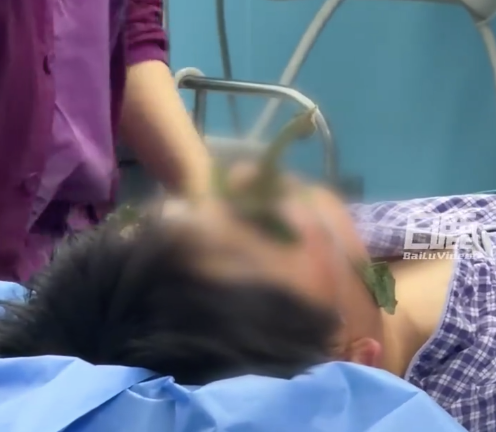 16岁男生被树枝从眼眶刺入脑内5cm 医生：万幸未直接戳破眼球