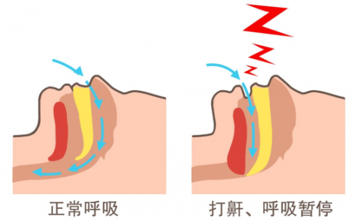 清雷科技：打鼾等于睡得香？容易被忽视的睡眠呼吸障碍