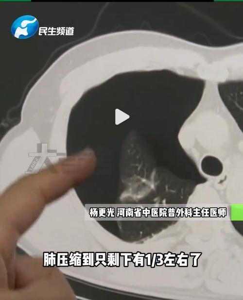 男子节后减肥连做20个俯卧撑 第二天发现“肺炸了” 剧烈运动致气胸