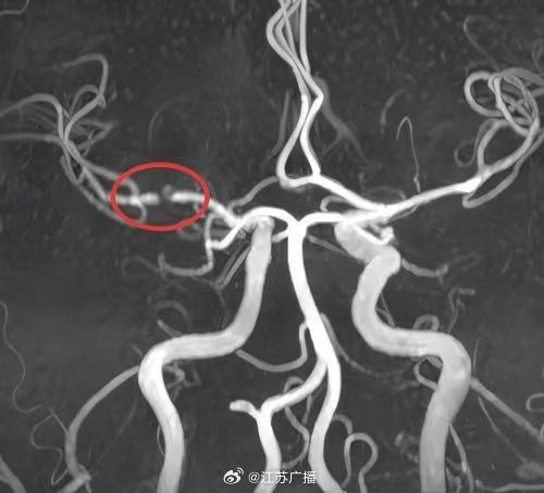 29岁230斤小伙一觉醒来突发脑梗 肥胖与不良习惯埋下隐患