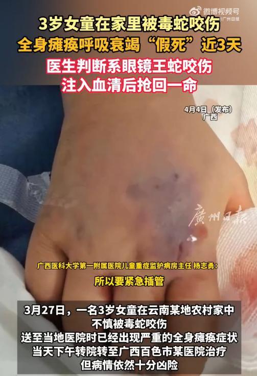 女童在家被眼镜王蛇咬伤后奇迹生还