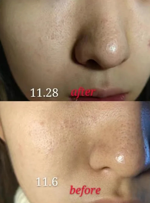 糖化脸和吃糖是什么关系？第一批奶皮子糖葫芦受害者现身