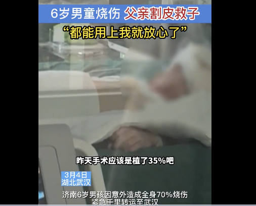 男童烧伤父亲割皮救子 一句“能用上就放心了”让人泪崩中华网 0976