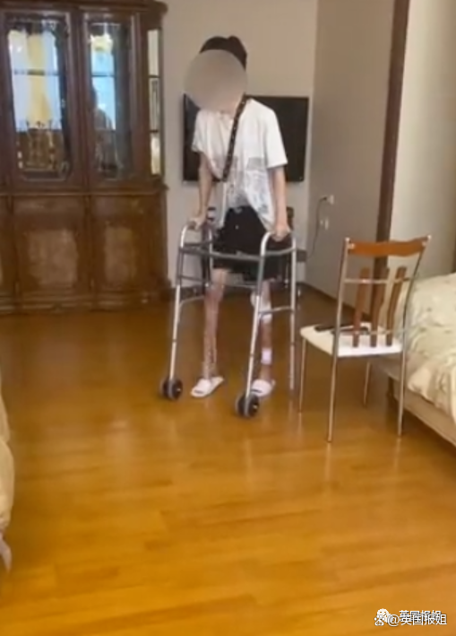 因丈夫喜欢大长腿，女模特砸120万断骨增高至1米8！如今自曝超后悔！