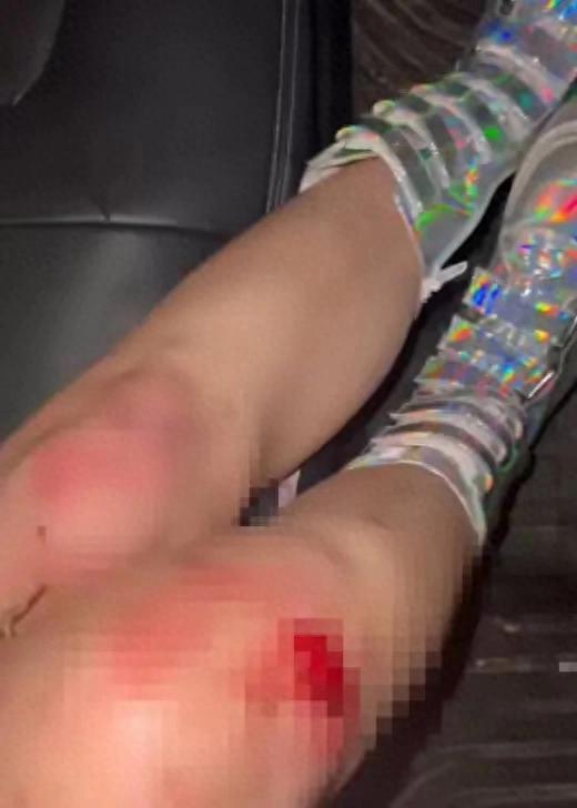 女生深夜打网约车起争执 下车后被司机狂追400米双腿摔伤