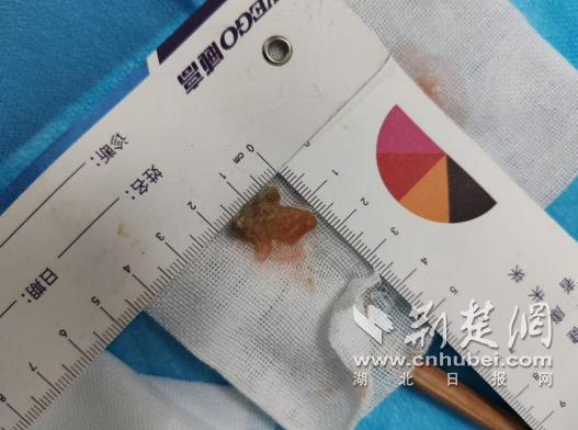 男子假牙卡喉险窒息医生取出 紧急微创手术化险为夷
