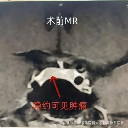 福州男子減肥一年增重30公斤 罕見(jiàn)病庫(kù)欣綜合征作祟