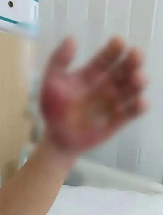 6岁男孩赤脚在沙滩踩到死鱼后住进ICU 警惕创伤弧菌感染