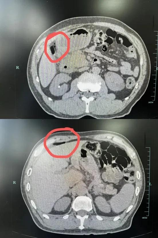 老人肚子“破大洞”竟是家常菜所致 春笋食用需谨慎