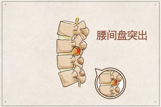 骨科专家介绍腰椎间盘突出的病因及治疗方法