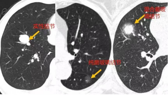 肺結節是癌症嗎?醫生回應 肺結節=患癌?