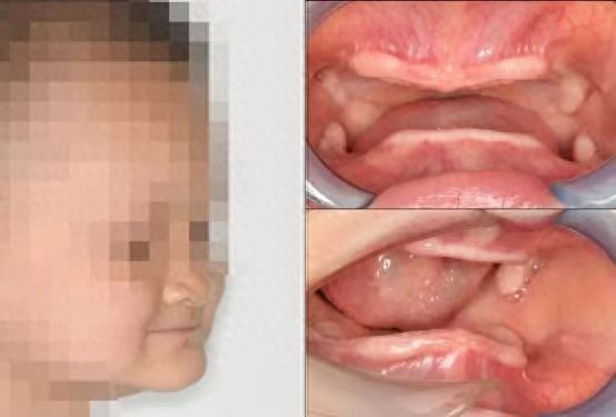 4岁男童患罕见无牙症 颌骨薄如纸片：天生没有牙齿，该怎么吃饭？