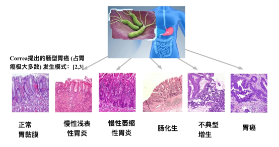 男生口臭2年险患癌体内发现罕见菌株 不规范治疗“喂养”出耐药菌
