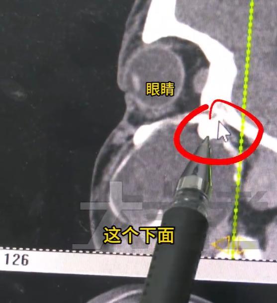 男孩智齿长到“眼窝”里 罕见案例引发关注