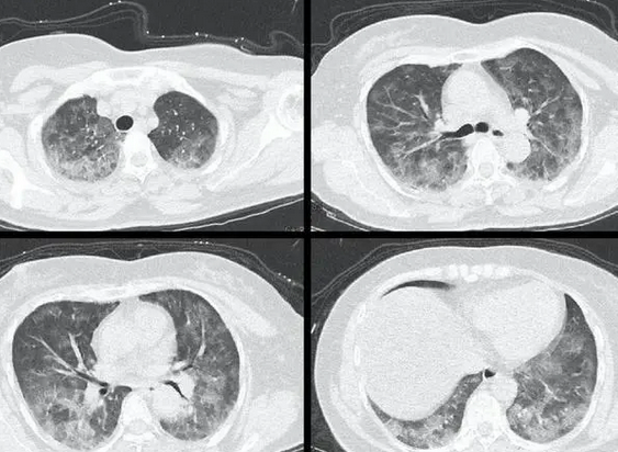 什么是“白肺”？肺真的会白吗？180秒视频强科普知识点