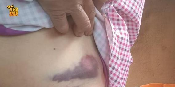 女子上班路上遭大狼狗扑咬血肉模糊 医药费赔偿引争议