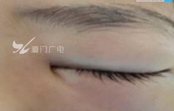 男孩时常抠鼻子揉眼睛致颅内感染进ICU