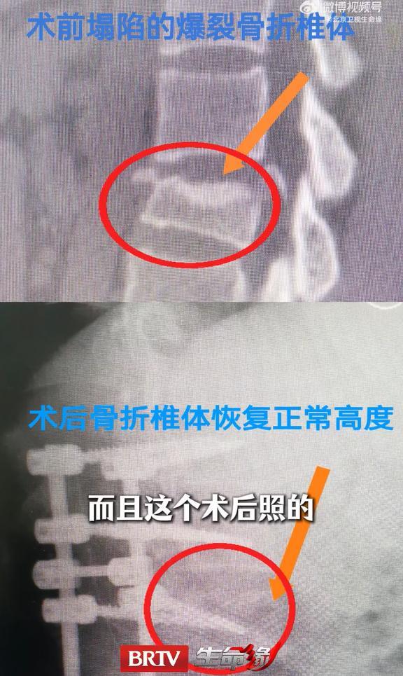 女孩下楼梯时玩手机摔骨折 低头族的致命风险
