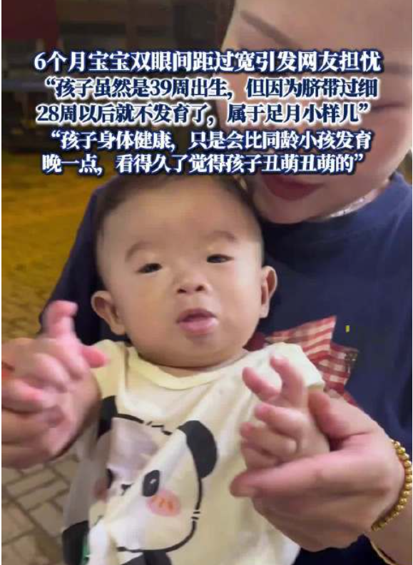 妈妈回应6个月宝宝眼距过宽引担忧 孩子健康发育稍晚