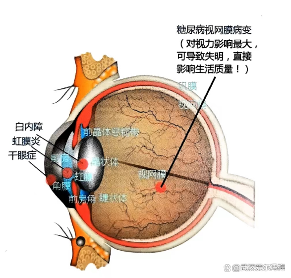 糖尿病患者能吃粽子吗？小心眼部并发症