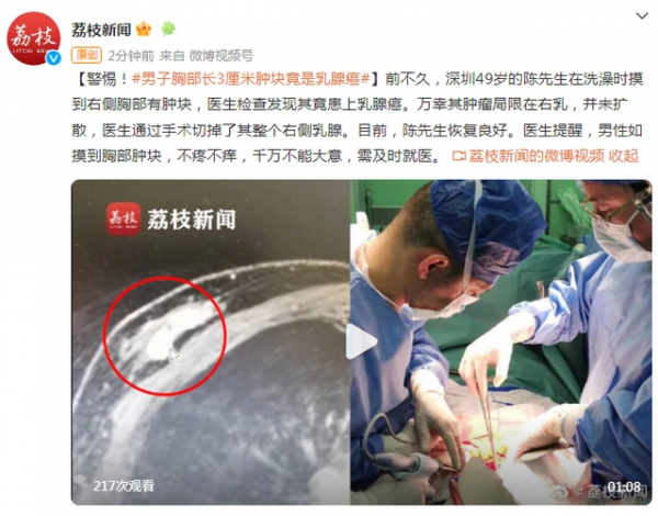 49岁男子胸口有肿块检查确诊乳腺癌  早就刺痛但幸运的是尚未转移