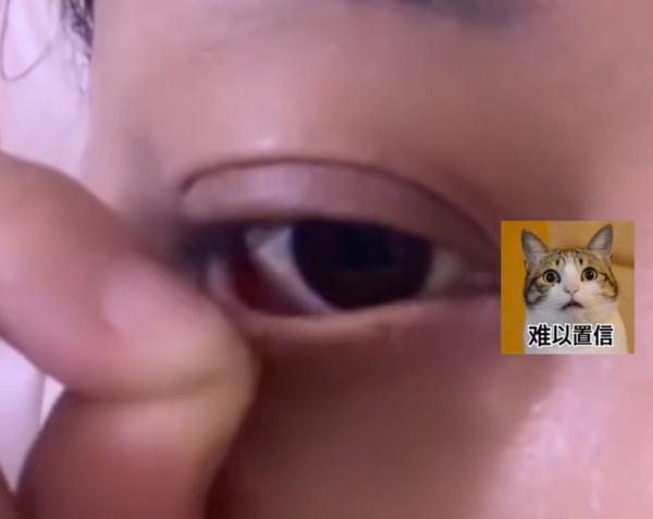 女子花3千元割眼袋致眼睛闭不合 一洗脸就进水难受得都想抠眼珠子