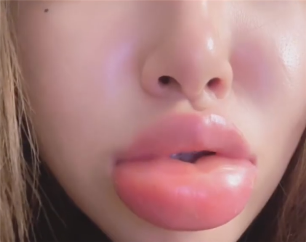 女生半夜嗦田螺 肿成香肠嘴：网友笑称终于超越梁朝伟