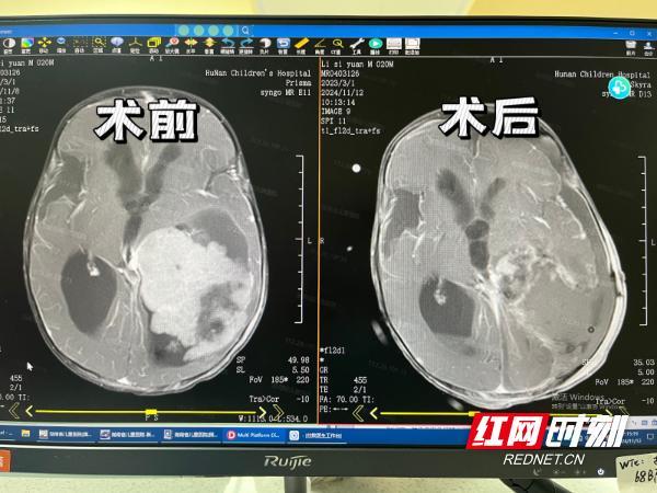 男童摔跤后发现脑瘤 意外受伤揭露隐疾