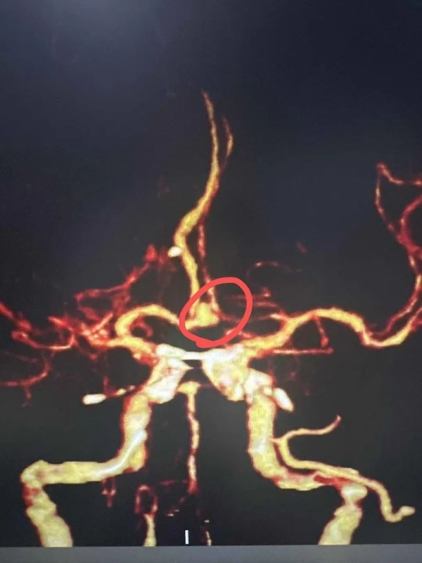 6兩白酒下肚引爆男子腦內(nèi)炸彈 酒精成“導(dǎo)火索”