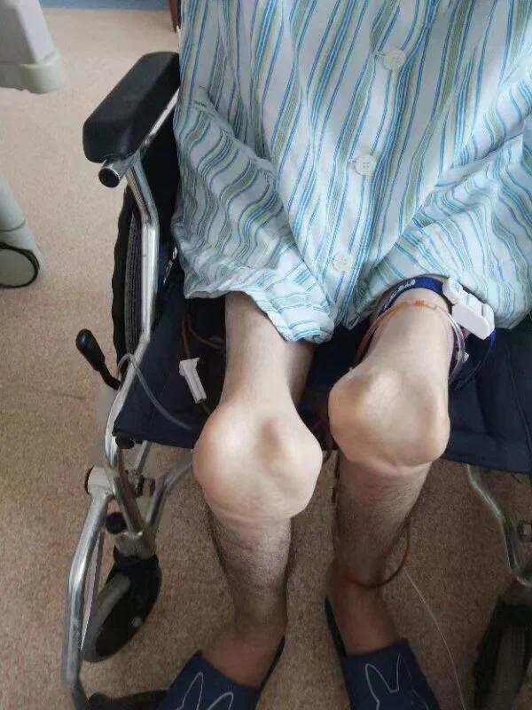 为了求药甘当“小白鼠”的人！骗保风波之后：一场“亡羊补牢”的困局