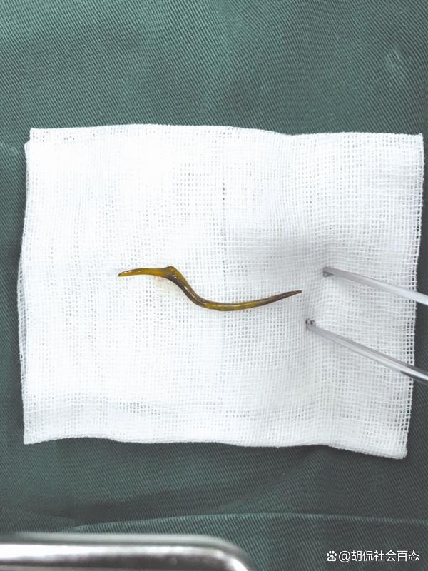 男子中午吃一条鱼 下午上班死亡 小鱼刺引发大悲剧