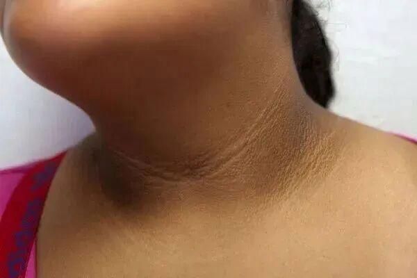 真的想问：脖子上一条条的“黑道道”，是胰岛素抵抗吗？不必太过担心