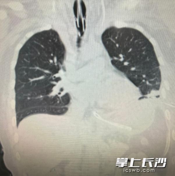 男子高空坠落心脏移位已出院 多学科协作创造生命奇迹