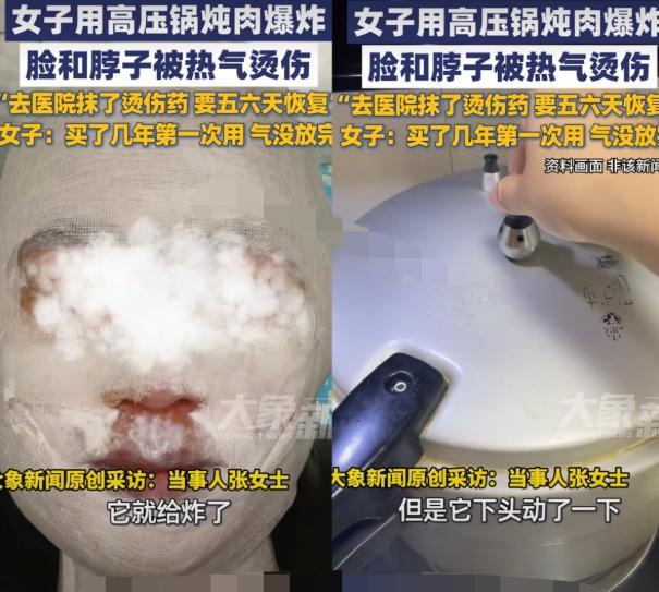 女子炖肉时高压锅爆炸被热气烫伤 安全操作需重视