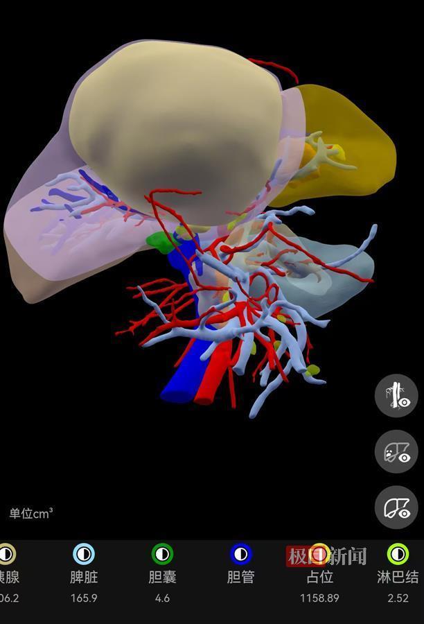 男子肝臟上藏巨大腫瘤 柚子大腫瘤成功切除