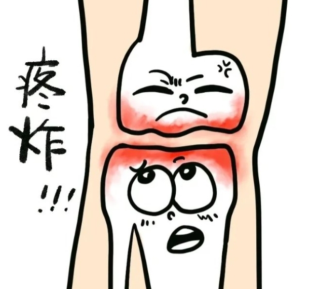 高强度运动警惕骨关节炎!氨基葡萄糖胶囊为关节健康护航