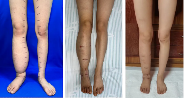 甘肃姑娘跨越千里来安徽瘦腿 超级显微术破解20年水肿难题