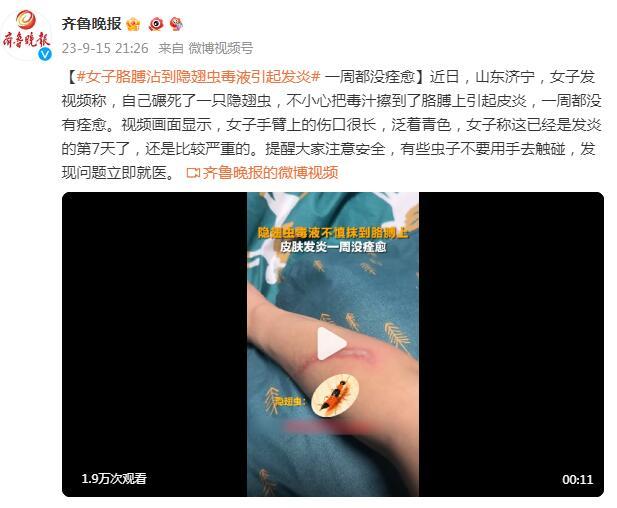 女子捏死隐翅虫手臂受伤7天还没好！这套实用防虫手册请收好