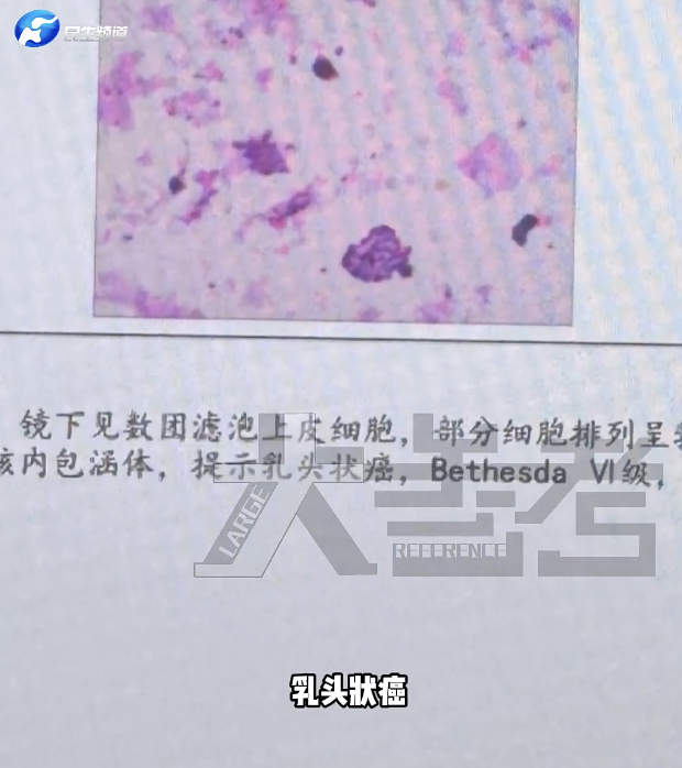 女老师经常加班熬夜查出甲状腺癌，经常凌晨1点才睡