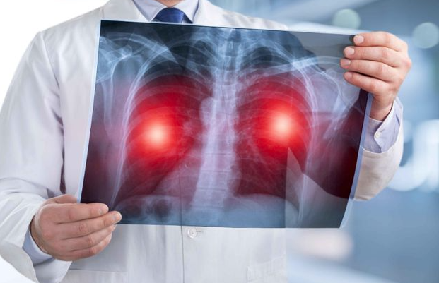 肺癌成为全球新增病例数最多癌症 全球发病率最高