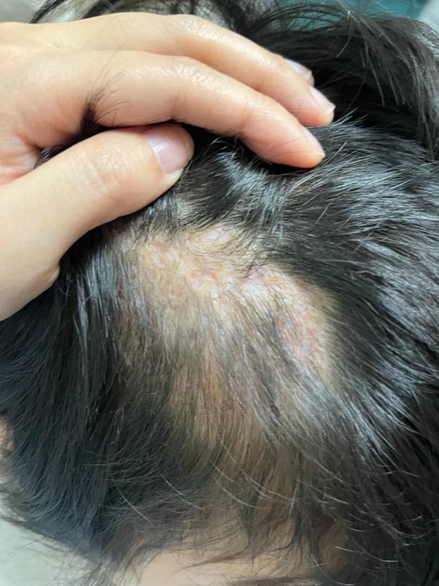 女童头上长出大脓包致永久性脱发 宠物接触成隐患