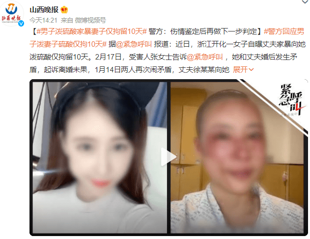 警方通报男子泼女子硫酸 女子浓硫酸烧伤11%双眼烧伤双耳烧伤